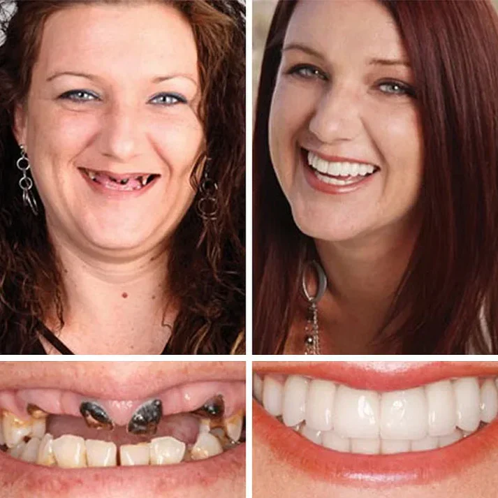 🎁Ends Today: 70% OFF! 🦷Advanced Customized Full Denture Set🦷 (🔥10,000+ Sold In Last 30 Day)