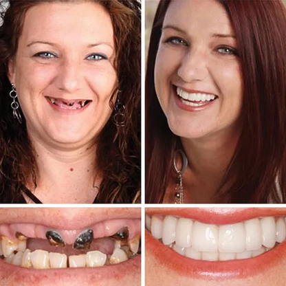 🎁Ends Today: 70% OFF! 🦷Advanced Customized Full Denture Set🦷 (🔥10,000+ Sold In Last 30 Day)