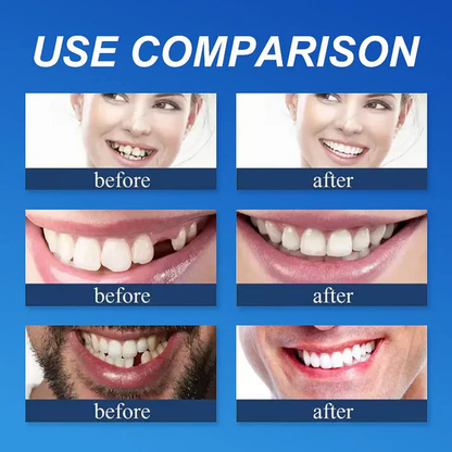 🎁Ends Today: 70% OFF! 🦷Advanced Customized Full Denture Set🦷 (🔥10,000+ Sold In Last 30 Day)