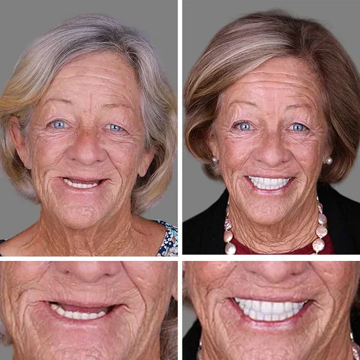 🎁Ends Today: 70% OFF! 🦷Advanced Customized Full Denture Set🦷 (🔥10,000+ Sold In Last 30 Day)