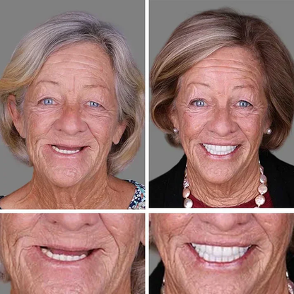 🎁Ends Today: 70% OFF! 🦷Advanced Customized Full Denture Set🦷 (🔥10,000+ Sold In Last 30 Day)
