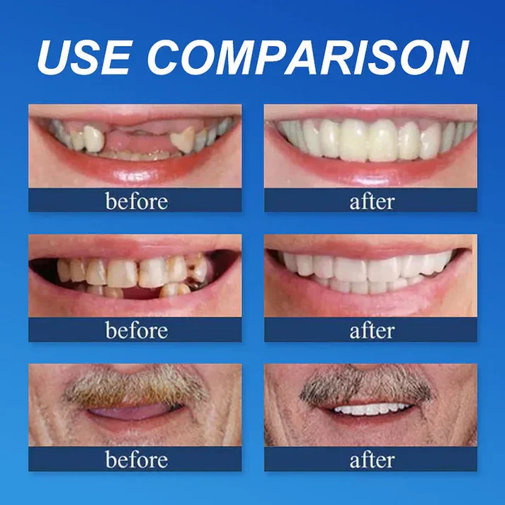 🎁Ends Today: 70% OFF! 🦷Advanced Customized Full Denture Set🦷 (🔥10,000+ Sold In Last 30 Day)