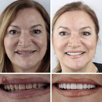 🎁Ends Today: 70% OFF! 🦷Advanced Customized Full Denture Set🦷 (🔥10,000+ Sold In Last 30 Day)