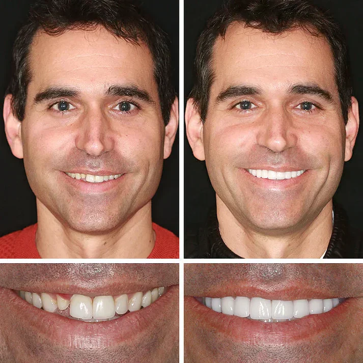 🎁Ends Today: 70% OFF! 🦷Advanced Customized Full Denture Set🦷 (🔥10,000+ Sold In Last 30 Day)